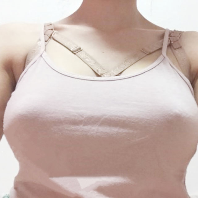 分享我自体脂肪隆胸手术的经历，还有前后对比果照片哦~