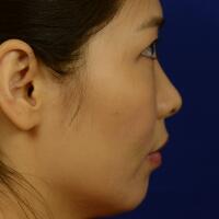 去医院做了面部埋埋蛋白线.提升，肌肤紧致果不错