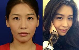 埋线蛋白提升前后对比图