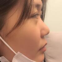 做鼻部综合整形真是一件正确的决定，鼻子恢复过程分享
