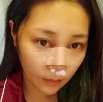 做鼻部综合整形真是一件正确的决定，鼻子恢复过程分享