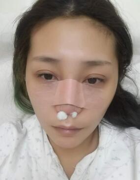 鼻部综合整形手术