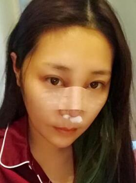 隆鼻整形手术第二天的照片