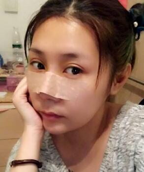 已经隆鼻整形第五天