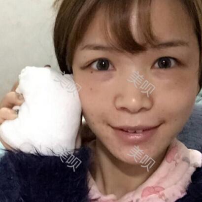 自体脂肪面部填充满脸的胶原蛋白让我基本甩掉了干瘪脸