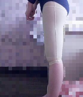 大腿吸脂40天果