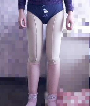 大腿吸脂40天果