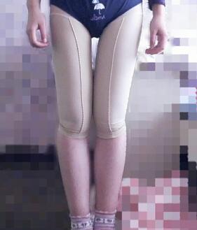 大腿吸脂40天果