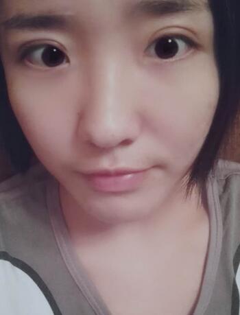 全切双眼皮2个月恢复图