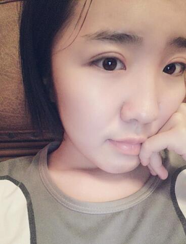 全切双眼皮2个月恢复图