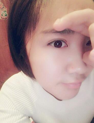 全切双眼皮2个月恢复图