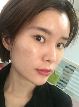 自体脂肪填充面部经验分享一下