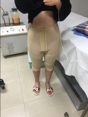 大腿吸脂改变了我的大象腿 夏天可以放肆海了