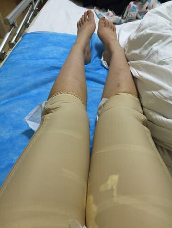 大腿吸脂改变了我的大象腿 夏天可以放肆海了
