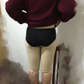 大腿吸脂改变了我的大象腿 夏天可以放肆海了