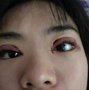 我的全切双眼皮整形经历 内有真实果图