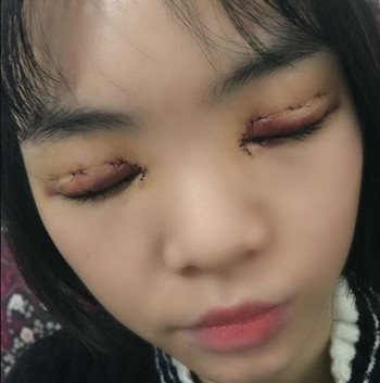 我的全切双眼皮整形经历 内有真实果图