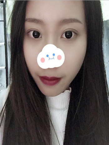 做了双眼皮改变了我眼睛无神的死鱼眼 果真的很不错