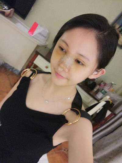 我做了耳软骨隆鼻割双眼皮以及去眼袋 项目太多但是果不错啊