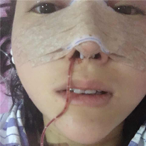 做隆鼻整形三个月了，分享手术过程和前后对比果照片~