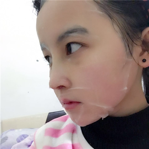 做隆鼻整形三个月了，分享手术过程和前后对比果照片~
