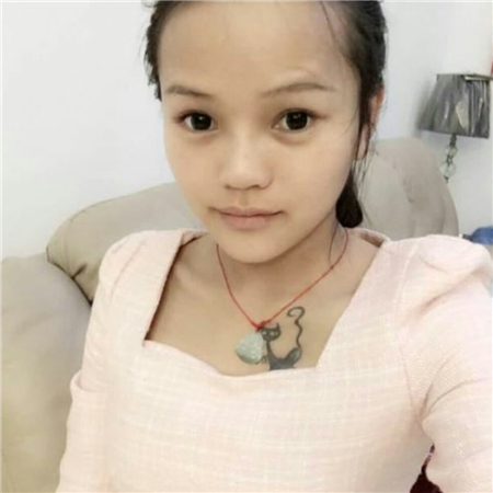 假体隆手术恢复过程分享，还有大量前后对比果照片哦~