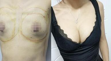 隆胸恢复过程和隆胸前后对比照片