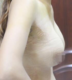 假体隆胸术后一周，拆完线