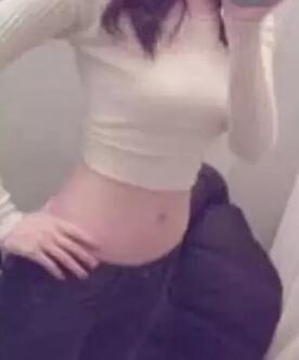 吸脂减肥手术3个多月了