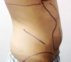 水动力吸脂减肥瘦腰腹，吸脂价格为11800元