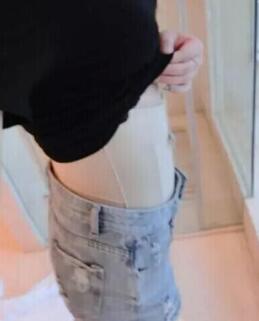 吸脂减肥瘦腰腹术后第7天