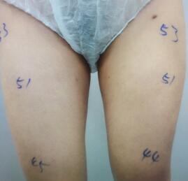 吸脂减肥瘦大腿