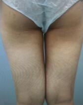 吸脂减肥瘦大腿术前