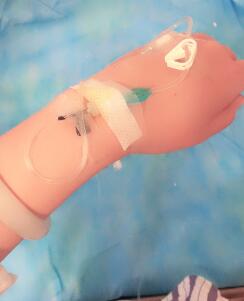 吸脂手术之后便在躺着输液