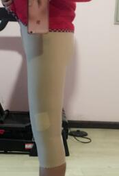 大腿吸脂减肥第5天了