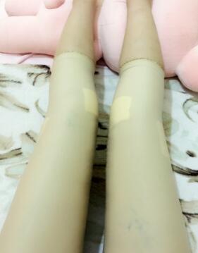 吸脂减肥瘦大腿第8天了，今天去拆线