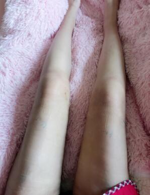 大腿吸脂手术后一直没有洗腿，不敢洗，怕伤口感染