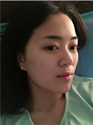 自体耳软骨隆鼻真人示范 果不要太好
