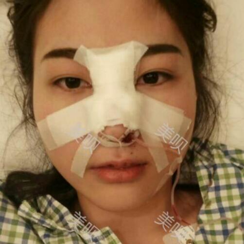 膨体隆鼻整形后我基本的告别了我的塌鼻梁