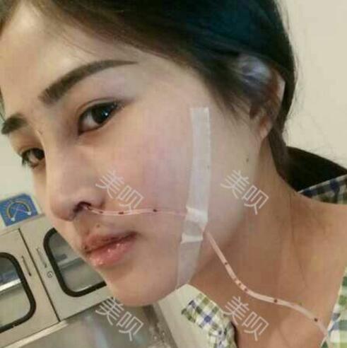 膨体隆鼻整形后我基本的告别了我的塌鼻梁