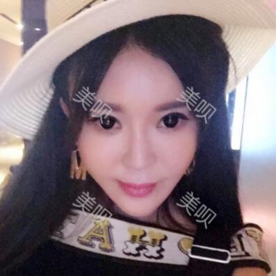 自体脂肪全脸填充让我变得年轻漂亮了