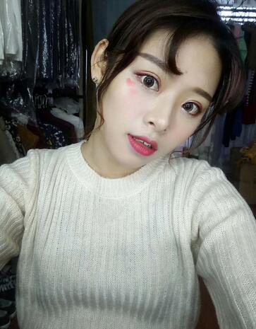 北京熙朵全切双眼皮1个月恢复日记