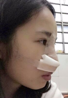 假体硅胶隆鼻真实感想分享~