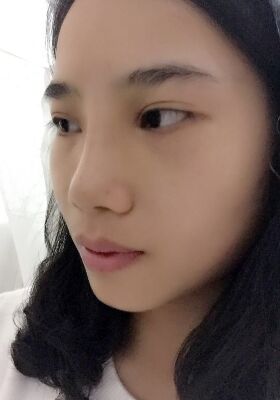 假体硅胶隆鼻真实感想分享~