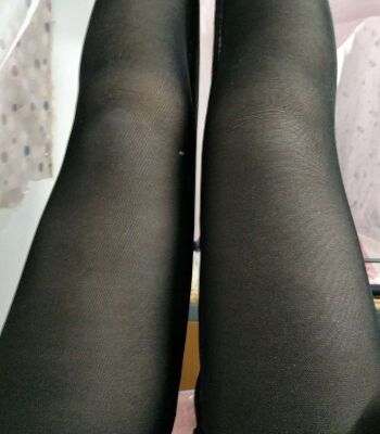 大腿抽脂日记 记录一下腿部变化