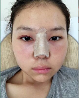 做隆鼻整形的亲身日记，气质完全不一样了