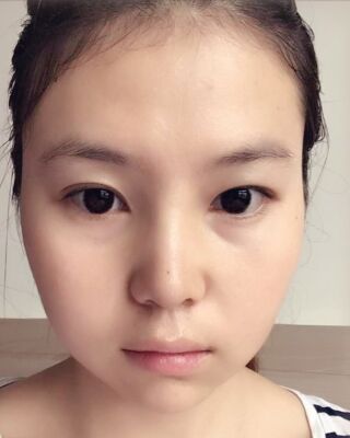 做隆鼻整形的亲身日记，气质完全不一样了