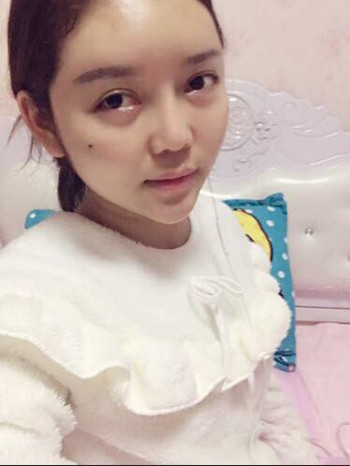 做了自体脂肪填充全脸果还不错 现在请叫元气少女