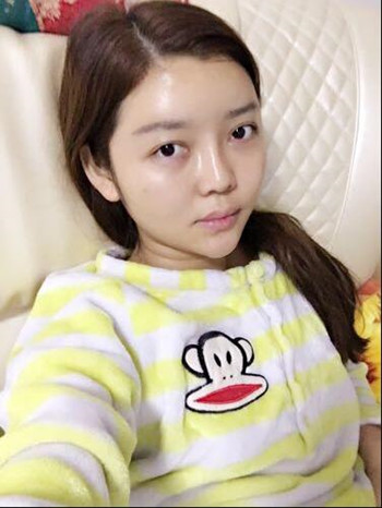 做了自体脂肪填充全脸果还不错 现在请叫元气少女