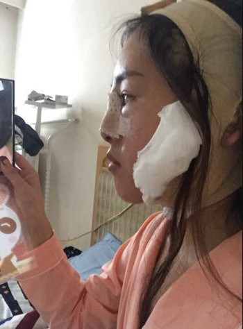 我在南昌佳美做的隆鼻整形+光纤溶脂去双下巴 果真的很不错